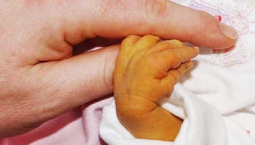 Dłoń dziecka- żółtaczka noworodkowa