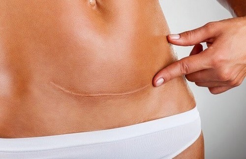 Blizna po cesarskim cięciu - efekty cesarskiego cięcia