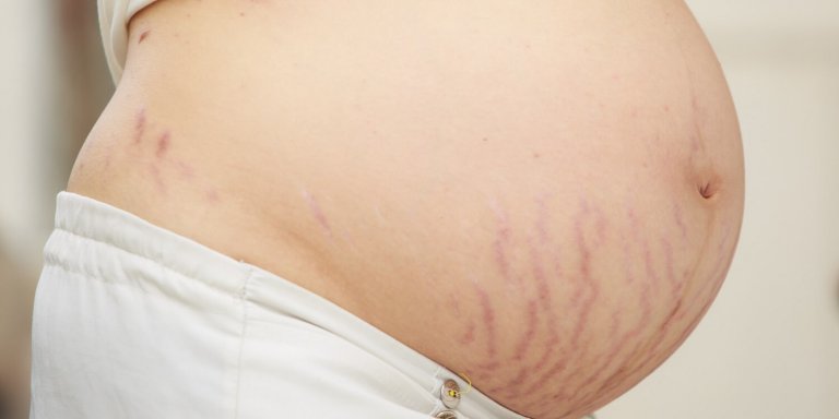Brzuch w ciąży z rozstępami - jak zwalczyć rozstępy po ciąży