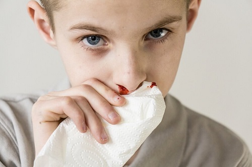 Krwawienie z nosa u dzieci – przyczyny i leczenie