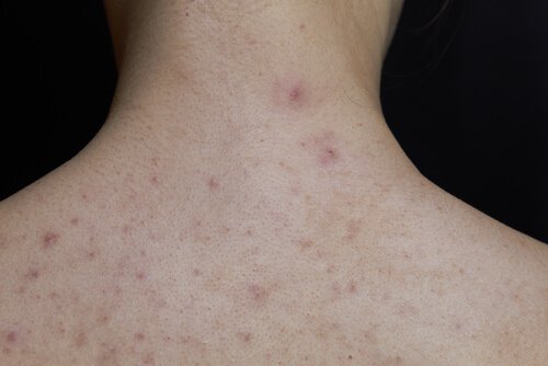 Kark dziecka z czerwoną wysypką