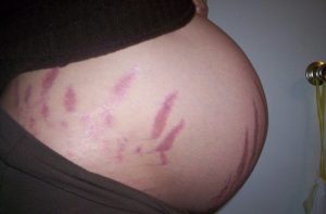 Rozstępy - dlaczego się pojawiają podczas ciąży