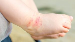 Atopowe zapalenie skóry u dziecka – jak z nim walczyć?
