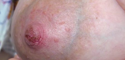 Obolałe i spękane sutki na piersiach kobiety