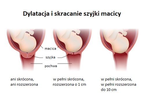 Dylatacja szyjki macicy