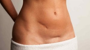 Zmniejszanie blizn i ich usuwanie – najlepsze sposoby