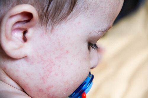 Najczęstsze alergie pokarmowe u dzieci