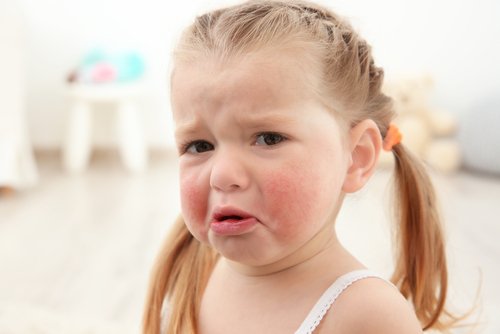Płacząca dziewczynka ze spuchniętymi, czerwonymi policzkami - alergie pokarmowe u dzieci