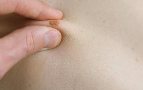 Kobieta ściskająca między palcami pieprzyk