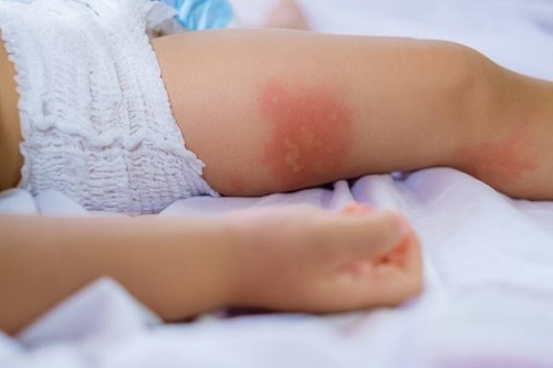 Pieluszkowe zapalenie skóry: zapobieganie i leczenie