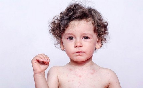 Reakcje alergiczne na pot u dzieci: ich objawy i leczenie