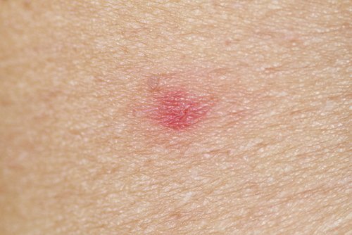 Zaczerwienienie na skórze