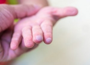 Pęcherze u dzieci - w jaki sposób je leczyć?
