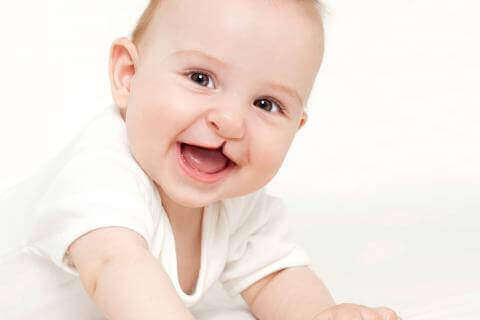 Dziecko z rozszczepioną wargą - anomalie twarzoczaszki