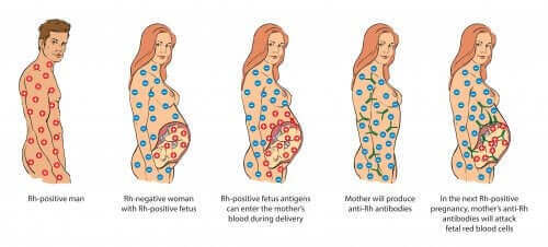 Konflikt serologiczny w ciąży