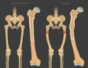Krzywica - niedobór witaminy D u dzieci