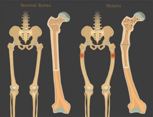 Krzywica - niedobór witaminy D u dzieci