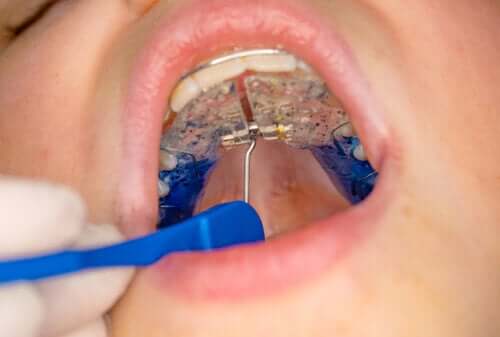 Podniebienie gotyckie lub o wysokim łuku u dzieci - dowiedz się więcej!