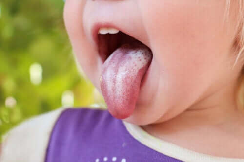 Kandydoza jamy ustnej u dzieci: objawy, przyczyny i leczenie